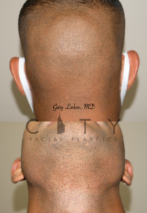 Hair transplant_8_case_5_donor sites