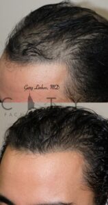 Hair Restoration NYC - Left