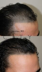 Hair Restoration NYC - Right
