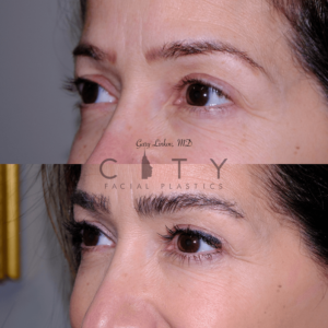Hair-transplant_19_case_3_L-oblique