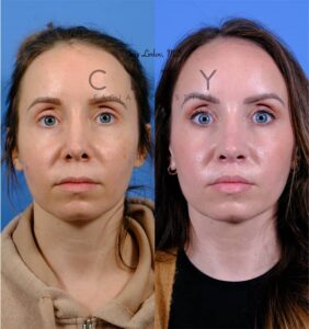 Lip-lift-52-case-7-frontal-mouth-closed
