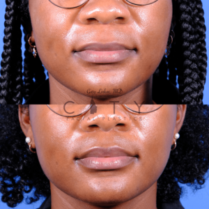 Frontal view, 3 months after NYC ethnic lip lift