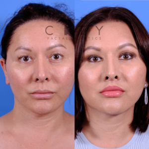 Front small view, 5 months after an elelyft lip lift