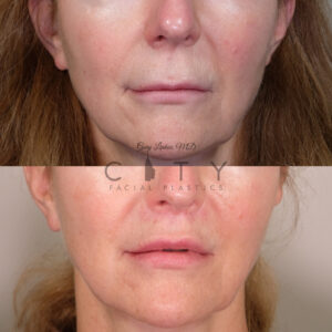 lip-lift-32-case-2-frontal-mouth-closed